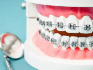 Comprehensive Guide to Braces Cost and Orthodontic Treatments in Ontario