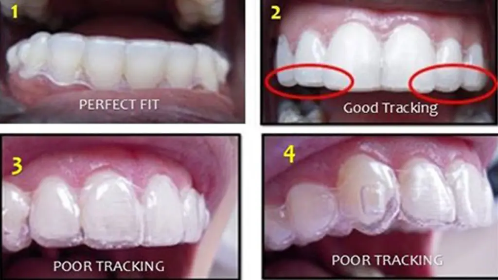 Invisalign Instructions - Wired Orthodontics